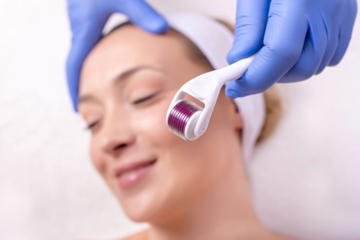 microneedling-how-to-take-optimal-care-for-skin