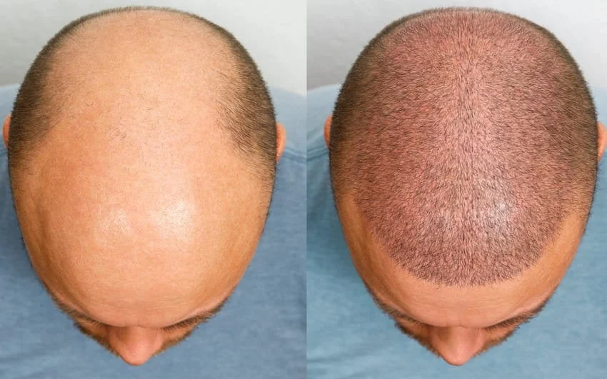 Hair Transplant